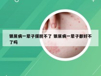 银屑病一辈子摆脱不了 银屑病一辈子都好不了吗