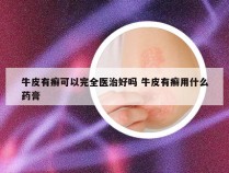 牛皮有癣可以完全医治好吗 牛皮有癣用什么药膏