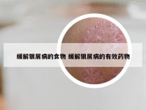 缓解银屑病的食物 缓解银屑病的有效药物