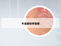 牛皮癣秋季很痒