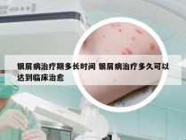 银屑病治疗期多长时间 银屑病治疗多久可以达到临床治愈