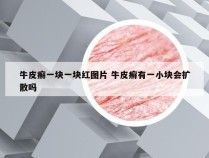牛皮癣一块一块红图片 牛皮癣有一小块会扩散吗