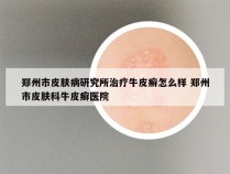 郑州市皮肤病研究所治疗牛皮癣怎么样 郑州市皮肤科牛皮癣医院