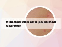 昆明牛皮癣哪家医院最权威 昆明最好的牛皮癣医院是哪家