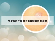 牛皮癣白介素 白介素类抑制剂 银屑病
