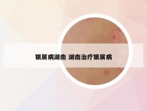银屑病湖南 湖南治疗银屑病