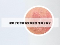 被蚊子叮牛皮癣复发价格 牛蚊子咬了