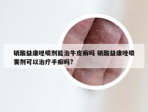 硝酸益康唑喷剂能治牛皮癣吗 硝酸益康唑喷雾剂可以治疗手癣吗?