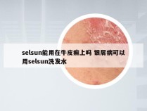 selsun能用在牛皮癣上吗 银屑病可以用selsun洗发水