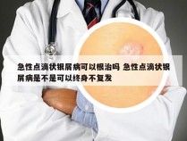 急性点滴状银屑病可以根治吗 急性点滴状银屑病是不是可以终身不复发