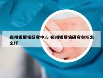 郑州银屑病研究中心 郑州银屑病研究会所怎么样