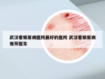 武汉看银屑病医院最好的医院 武汉看银屑病推荐医生