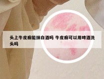 头上牛皮癣能抹白酒吗 牛皮癣可以用啤酒洗头吗