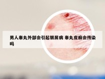 男人睾丸外部会引起银屑病 睾丸皮癣会传染吗