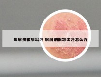 银屑病很难出汗 银屑病很难出汗怎么办