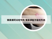 银屑病可以吃牛吗 银屑病能不能吃牛肉