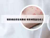银屑病皮疹处有颗痣 银屑病覆盖在痣上