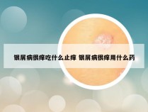 银屑病很痒吃什么止痒 银屑病很痒用什么药