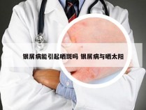 银屑病能引起晒斑吗 银屑病与晒太阳