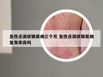 急性点滴状银屑病三个月 急性点滴状银屑病复发率高吗