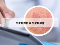 牛皮癣做抗体 牛皮癣筛查