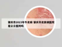 肇庆市2023年牛皮癣 肇庆市皮肤病医院是公立医院吗