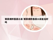 银屑病转基因小鼠 银屑病转基因小鼠能治好吗