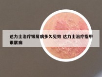 达力士治疗银屑病多久见效 达力士治疗指甲银屑病
