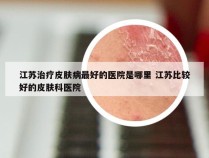 江苏治疗皮肤病最好的医院是哪里 江苏比较好的皮肤科医院
