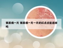 银屑病一片 银屑病一片一片的红点点能退掉吗