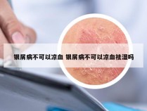 银屑病不可以凉血 银屑病不可以凉血祛湿吗