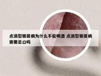 点滴型银屑病为什么不能喝酒 点滴型银屑病需要忌口吗