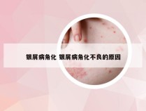 银屑病角化 银屑病角化不良的原因