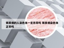 银屑病的人染色体一定异常吗 银屑病染色体正常吗