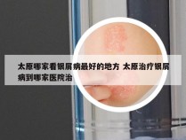 太原哪家看银屑病最好的地方 太原治疗银屑病到哪家医院治