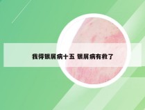 我得银屑病十五 银屑病有救了