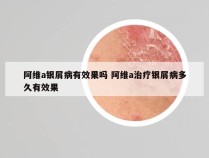 阿维a银屑病有效果吗 阿维a治疗银屑病多久有效果