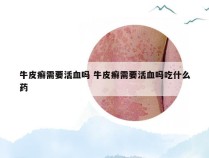 牛皮癣需要活血吗 牛皮癣需要活血吗吃什么药