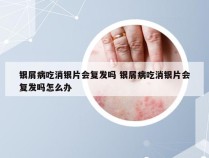 银屑病吃消银片会复发吗 银屑病吃消银片会复发吗怎么办