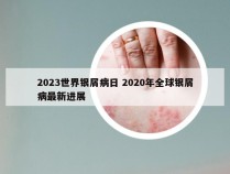 2023世界银屑病日 2020年全球银屑病最新进展