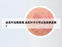 丝瓜叶治银屑病 丝瓜叶子汁可以治皮肤皮癣?