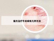 偏方治疗牛皮癣有几种方法