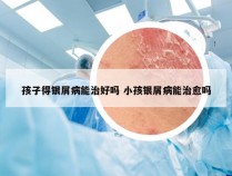 孩子得银屑病能治好吗 小孩银屑病能治愈吗