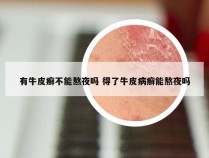 有牛皮癣不能熬夜吗 得了牛皮病癣能熬夜吗