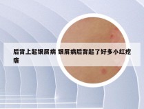 后背上起银屑病 银屑病后背起了好多小红疙瘩