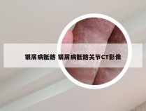 银屑病骶髂 银屑病骶髂关节CT影像