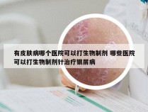 有皮肤病哪个医院可以打生物制剂 哪些医院可以打生物制剂针治疗银屑病