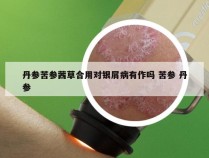 丹参苦参茜草合用对银屑病有作吗 苦参 丹参