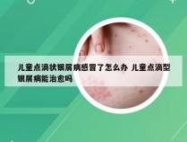 儿童点滴状银屑病感冒了怎么办 儿童点滴型银屑病能治愈吗