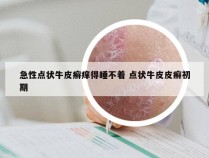 急性点状牛皮癣痒得睡不着 点状牛皮皮癣初期
